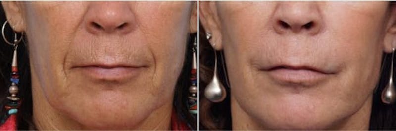 Dr. Balikian's Laser / Chemical Peel Gallery - Patient 2167482 - Image 1
