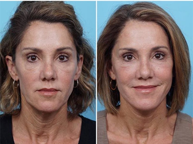 Dr. Balikian's Laser / Chemical Peel Before & After Gallery - Patient 2167484 - Image 1