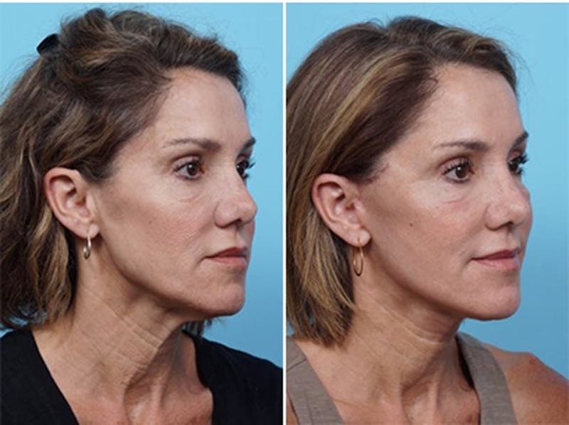 Dr. Balikian's Laser / Chemical Peel Before & After Gallery - Patient 2167484 - Image 2