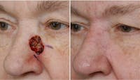 Dr. Balikian's Reconstruction / Scar Revision Before & After Gallery - Patient 2167486 - Image 1