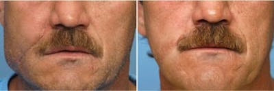 Dr. Balikian's Reconstruction / Scar Revision Before & After Gallery - Patient 2167490 - Image 1