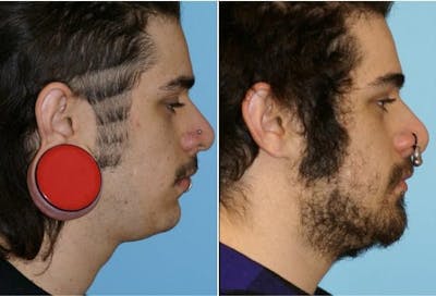 Dr. Balikian's Reconstruction / Scar Revision Before & After Gallery - Patient 2167494 - Image 1