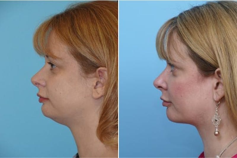Dr. Balikian's Liposuction Before & After Gallery - Patient 2167497 - Image 1
