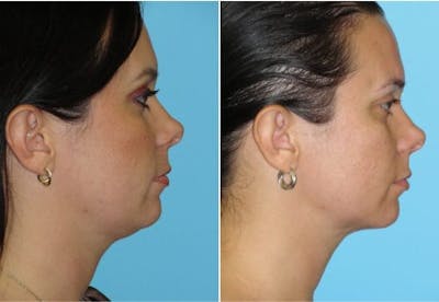 Dr. Balikian's Liposuction Before & After Gallery - Patient 2167499 - Image 1