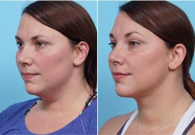 Dr. Balikian's Liposuction Before & After Gallery - Patient 2167501 - Image 1