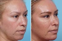 Dr. Balikian's Liposuction Before & After Gallery - Patient 2167503 - Image 1