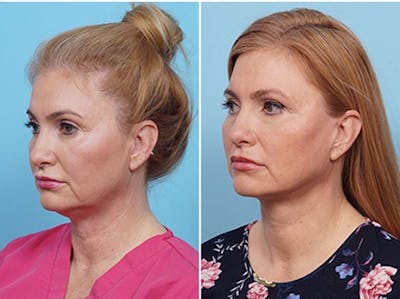 Dr. Balikian's Liposuction Before & After Gallery - Patient 2167505 - Image 1