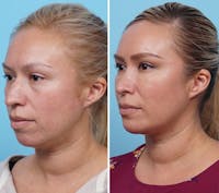 Dr. Balikian's Chin Implant Before & After Gallery - Patient 2167512 - Image 1