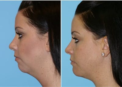 Dr. Balikian's Chin Implant Before & After Gallery - Patient 2167514 - Image 1