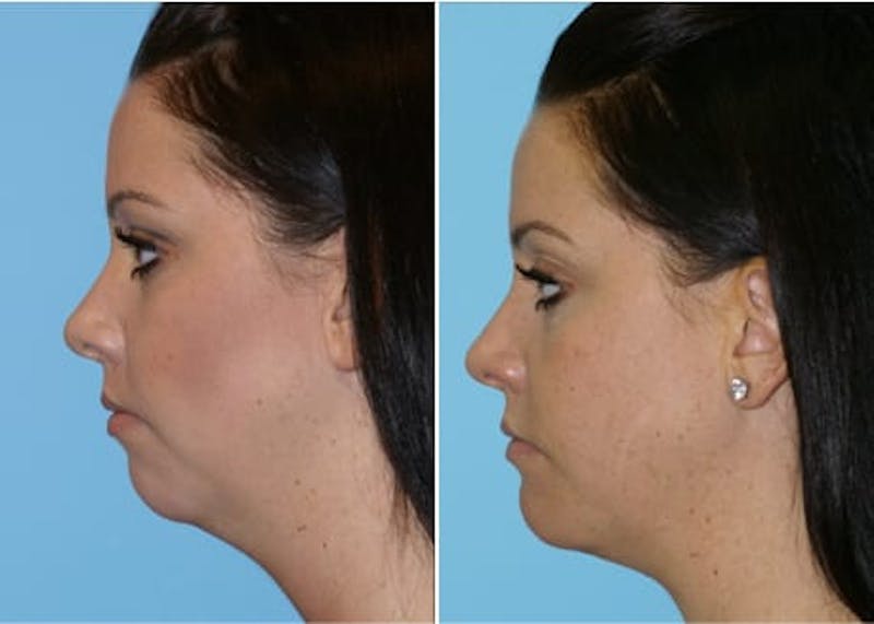 Dr. Balikian's Chin Implant Before & After Gallery - Patient 2167514 - Image 1