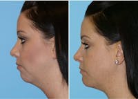 Dr. Balikian's Chin Implant Before & After Gallery - Patient 2167514 - Image 1