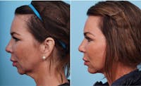 Dr. Balikian's Chin Implant Before & After Gallery - Patient 2167516 - Image 1