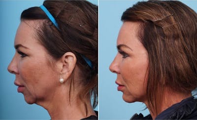 Dr. Balikian's Chin Implant Before & After Gallery - Patient 2167516 - Image 1