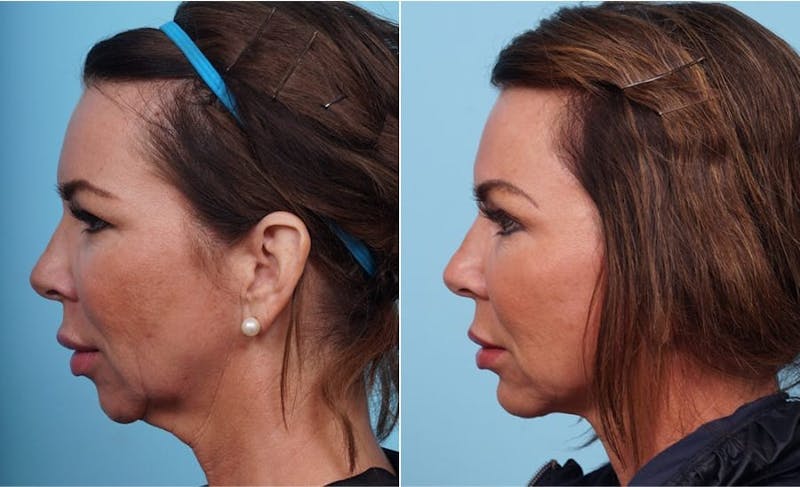 Dr. Balikian's Chin Implant Before & After Gallery - Patient 2167516 - Image 1