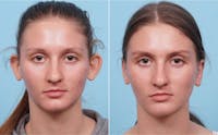 Dr. Balikian's Otoplasty Before & After Gallery - Patient 2167518 - Image 1