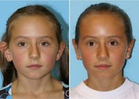 Dr. Balikian's Otoplasty Before & After Gallery - Patient 2167520 - Image 1