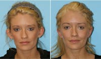 Dr. Balikian's Otoplasty Before & After Gallery - Patient 2167523 - Image 1