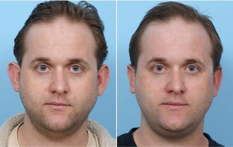 Dr. Balikian's Otoplasty Before & After Gallery - Patient 2167527 - Image 1