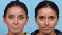 Dr. Balikian's Otoplasty Before & After Gallery - Patient 2167529 - Image 1