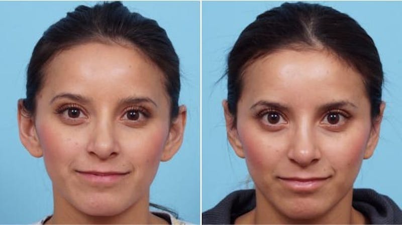 Dr. Balikian's Otoplasty Before & After Gallery - Patient 2167529 - Image 1