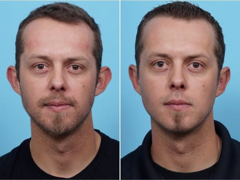 Dr. Balikian's Otoplasty Before & After Gallery - Patient 2167531 - Image 1