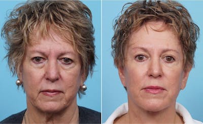Dr. Balikian's Fat Transfer Before & After Gallery - Patient 2167534 - Image 1
