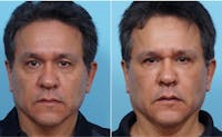 Dr. Balikian's Fat Transfer Before & After Gallery - Patient 2167536 - Image 1