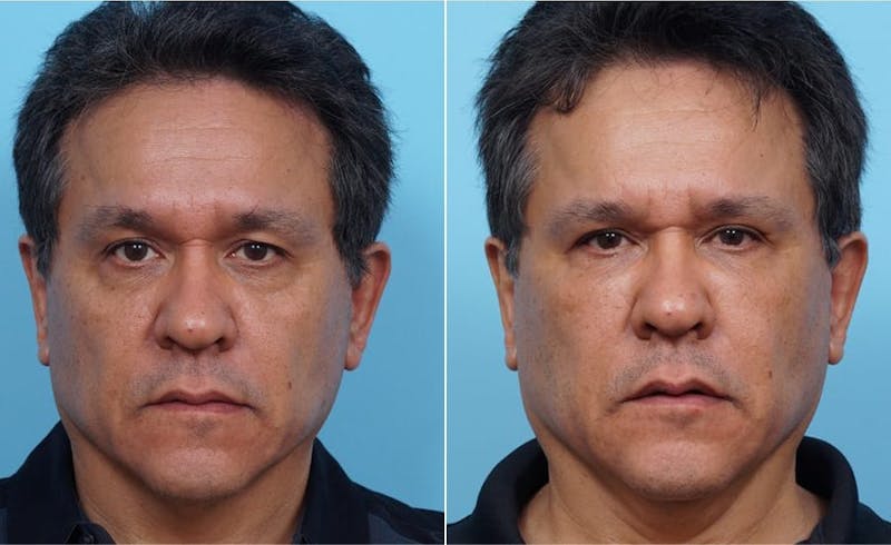 Dr. Balikian's Fat Transfer Before & After Gallery - Patient 2167536 - Image 1