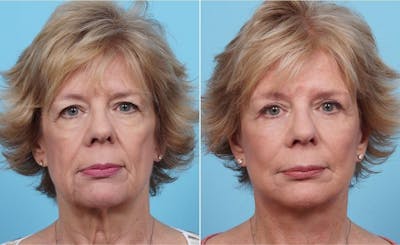 Dr. Balikian's Fat Transfer Before & After Gallery - Patient 2167538 - Image 1