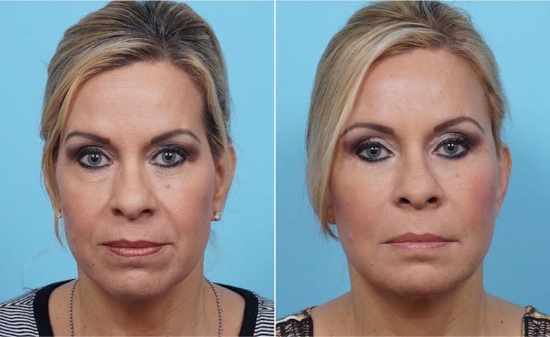 Dr. Balikian's Fat Transfer Before & After Gallery - Patient 2167540 - Image 1