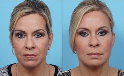Dr. Balikian's Fat Transfer Before & After Gallery - Patient 2167540 - Image 1