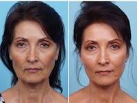 Dr. Balikian's Fat Transfer Before & After Gallery - Patient 2167542 - Image 1