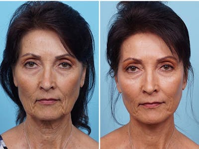Dr. Balikian's Fat Transfer Before & After Gallery - Patient 2167542 - Image 1