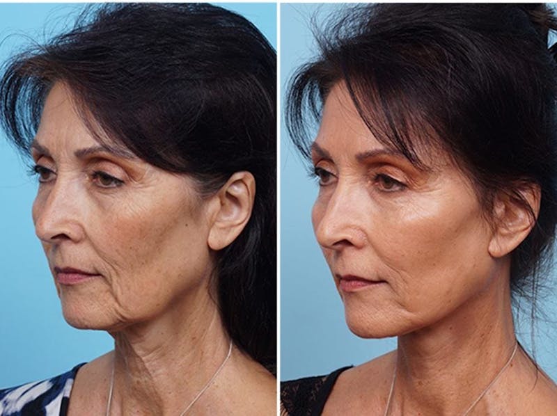 Dr. Balikian's Fat Transfer Before & After Gallery - Patient 2167542 - Image 2