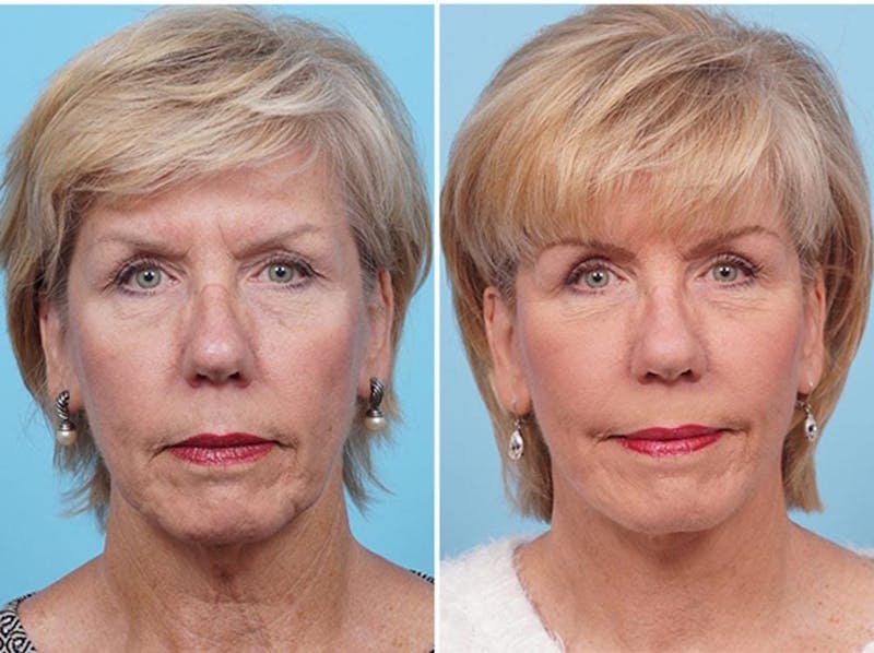 Dr. Balikian's Fat Transfer Before & After Gallery - Patient 2167544 - Image 1