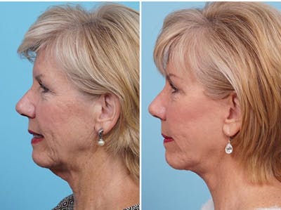 Dr. Balikian's Fat Transfer Before & After Gallery - Patient 2167544 - Image 2