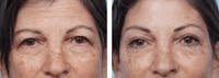 Dr. Balikian's Brow Lift Before & After Gallery - Patient 2167546 - Image 1