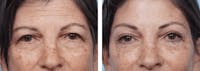 Dr. Balikian's Brow Lift Gallery - Patient 2167546 - Image 1