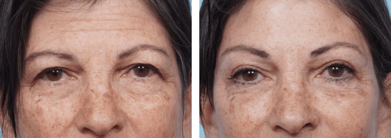 Dr. Balikian's Brow Lift Before & After Gallery - Patient 2167546 - Image 1