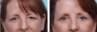 Dr. Balikian's Brow Lift Before & After Gallery - Patient 2167548 - Image 1