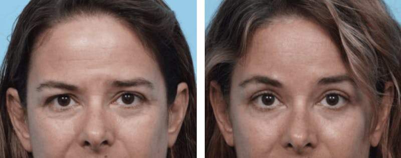 Dr. Balikian's Brow Lift Before & After Gallery - Patient 2167550 - Image 1