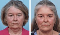 Dr. Balikian's Brow Lift Before & After Gallery - Patient 2167552 - Image 1