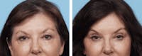 Dr. Balikian's Brow Lift Before & After Gallery - Patient 2167554 - Image 1
