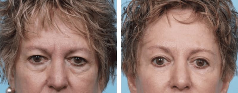Dr. Balikian's Brow Lift Before & After Gallery - Patient 2167557 - Image 1
