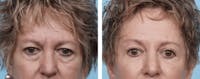 Dr. Balikian's Brow Lift Before & After Gallery - Patient 2167557 - Image 1