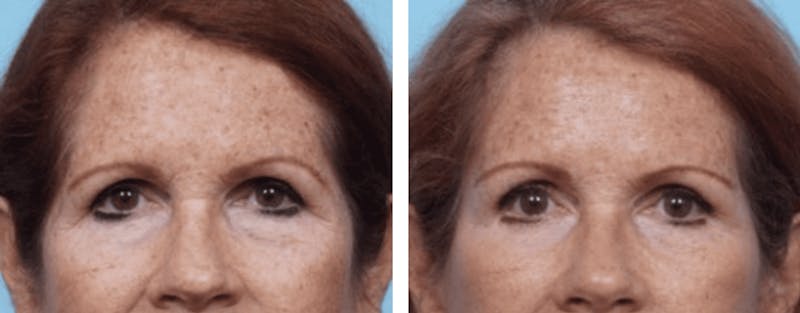 Dr. Balikian's Brow Lift Before & After Gallery - Patient 2167559 - Image 1