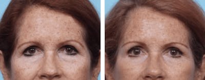 Dr. Balikian's Brow Lift Before & After Gallery - Patient 2167559 - Image 1