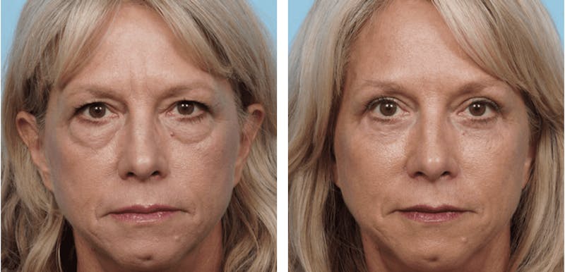 Dr. Balikian's Brow Lift Before & After Gallery - Patient 2167561 - Image 1