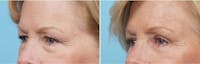 Dr. Balikian's Brow Lift Before & After Gallery - Patient 2167573 - Image 1