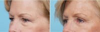 Dr. Balikian's Brow Lift Gallery - Patient 2167573 - Image 1